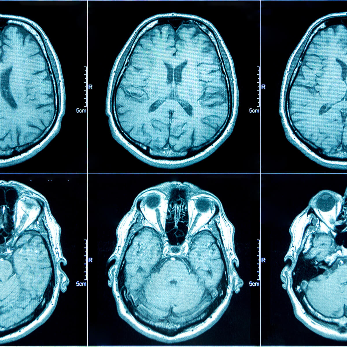 MRI  to diagnose epilpsey